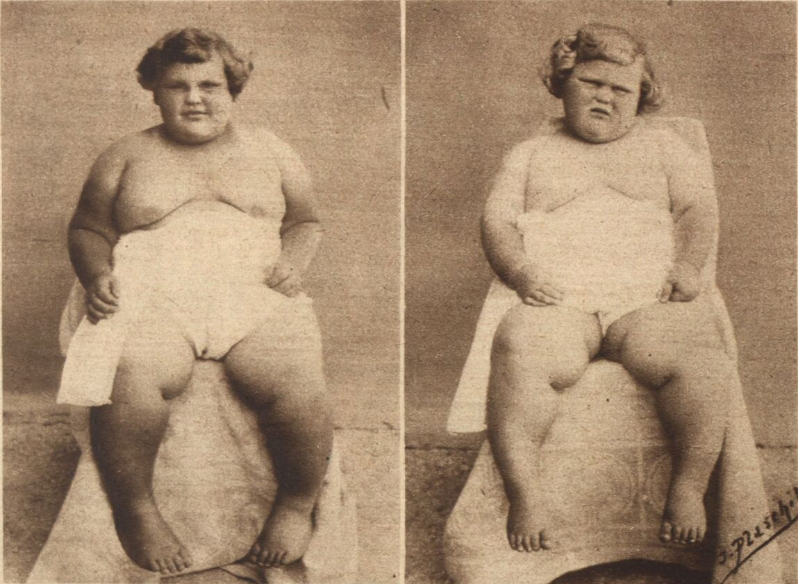 Die Geschwister Nissler 1927: Toni (links) 6 Jahre und 7 Monate alt, 86 kg und Wetti (rechts) 3 Jahre und 10 Monate alt, 48,5 kg